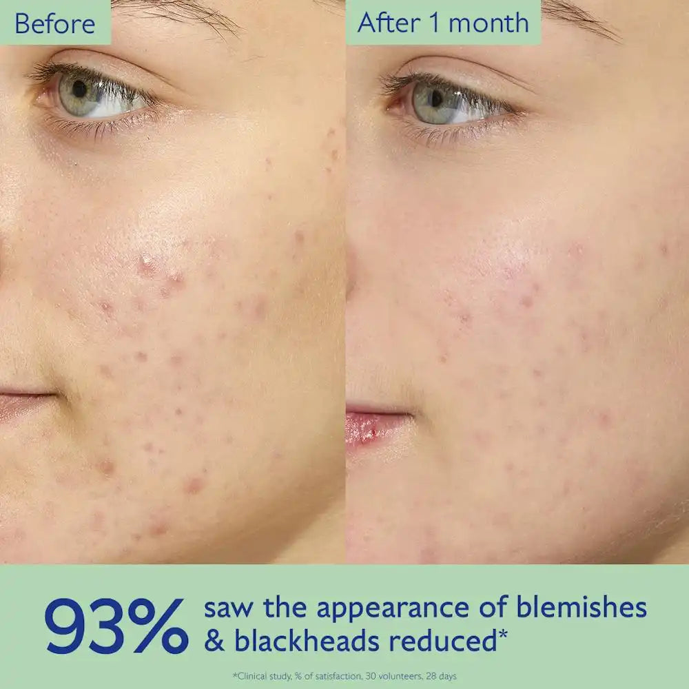 Oil-Control Moisturizer for Acne Prone Skin